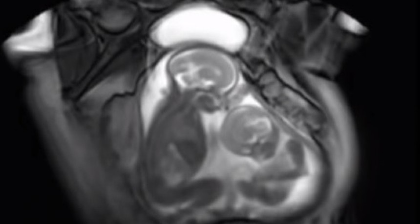 La ecografía viral que muestra a dos bebés “peleando” en la panza de su madre