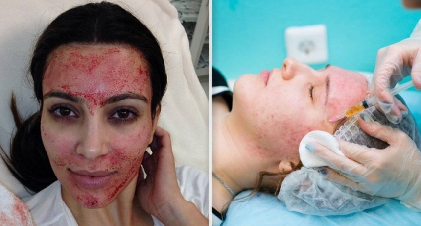 Una mujer se contagió VIH por imitar el tratamiento facial vampiro de Kim Kardashian