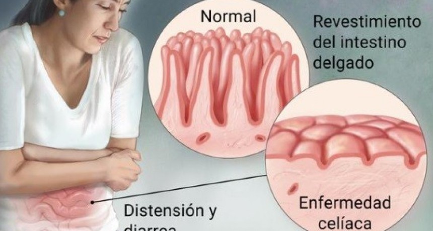 Las obras sociales y prepagas deberán aumentar el monto de cobertura por alimentos a las personas celíacas