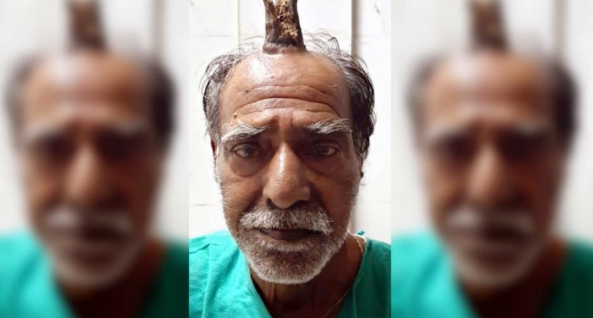 Le extirparon un cuerno de 10 centímetros que le creció en medio de la cabeza