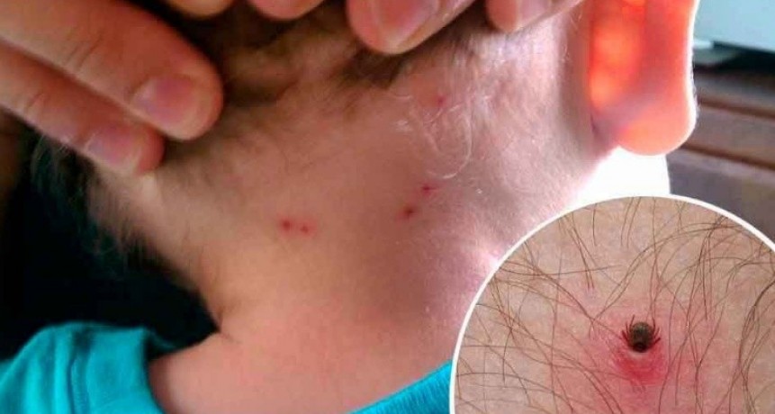 ALERTA: Por peligrosa enfermedad por picaduras de garrapatas