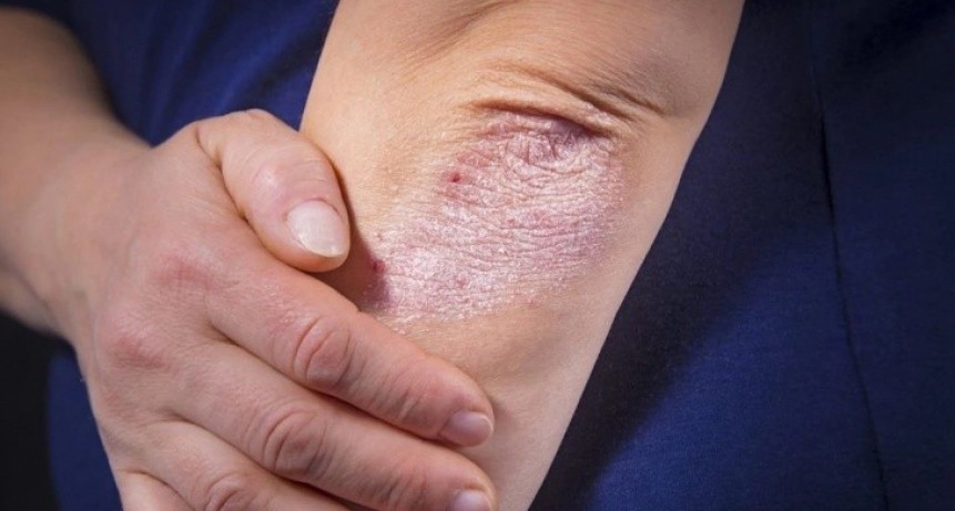 Campa&ntilde;a de detecci&oacute;n de psoriasis gratuita y sin turno en hospitales