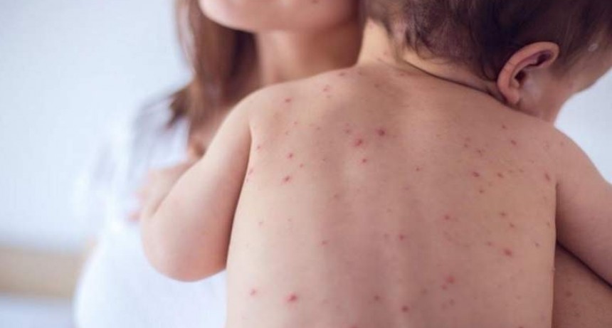 Argentina sufre el peor brote de sarampión en casi 20 años